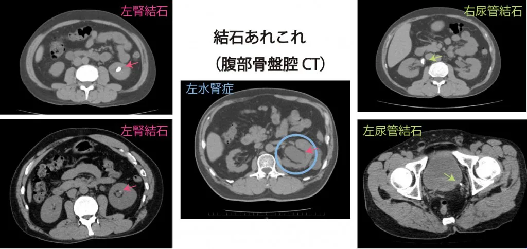 尿路結石の発作 痛み について こだいら泌尿器科